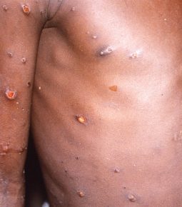 OMS relata 131 casos de varíola dos macacos no mundo